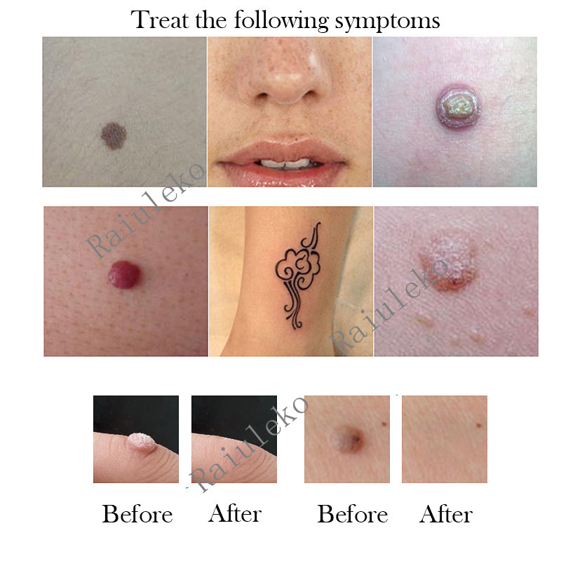 Laser Quita Pecas y Manchas Recargable